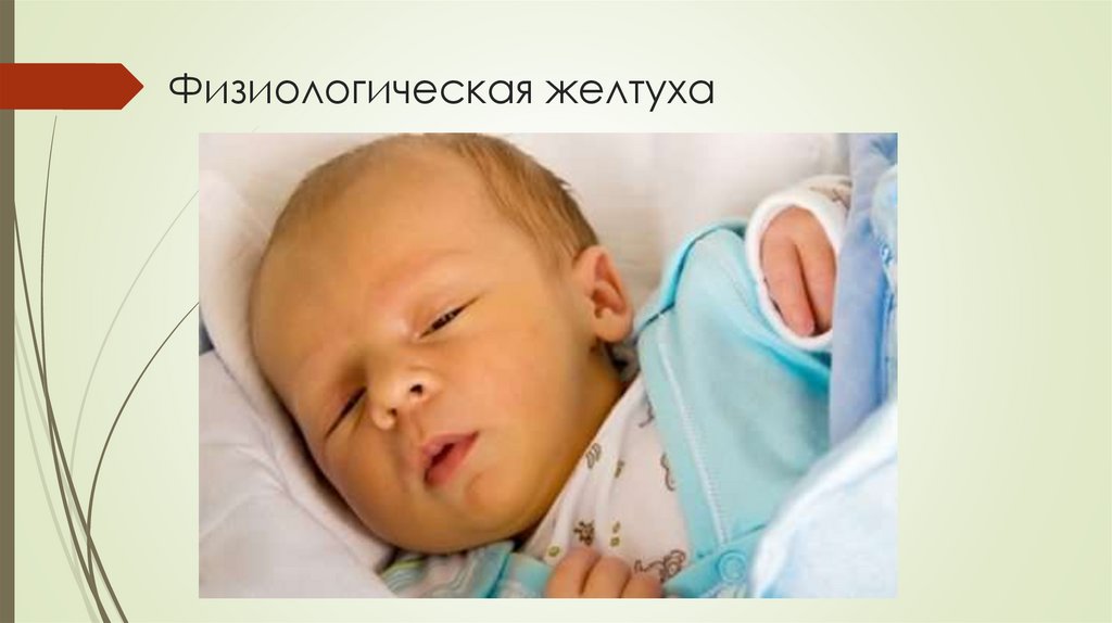 Физиологическая желтуха