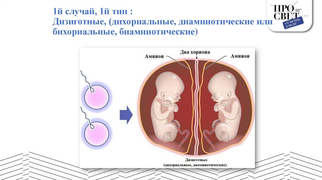1й случай, 1й тип : Дизиготные, (дихориальные, диамниотические или бихориальные, биамниотические)