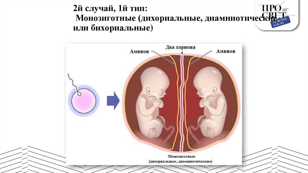 2й случай, 1й тип: Монозиготные (дихориальные, диамниотические или бихориальные)