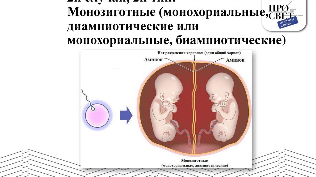 2й случай, 2й тип: Монозиготные (монохориальные, диамниотические или монохориальные, биамниотические)