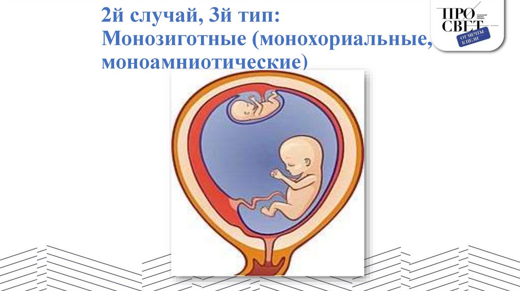 2й случай, 3й тип: Монозиготные (монохориальные, моноамниотические)