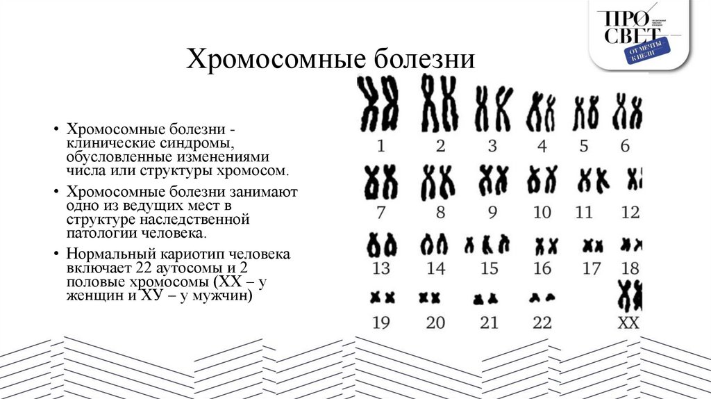 Хромосомные болезни