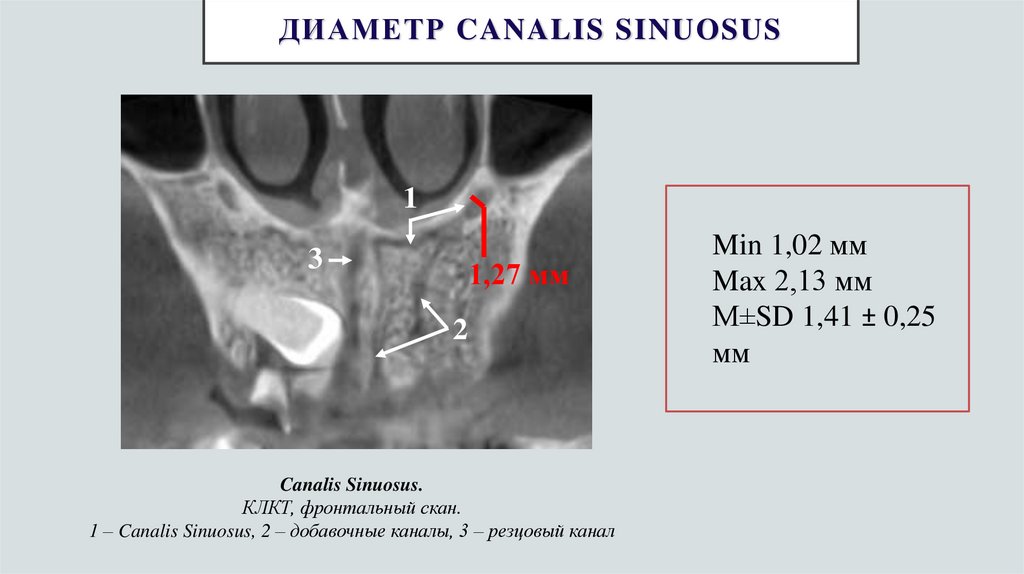 Диаметр Canalis Sinuosus