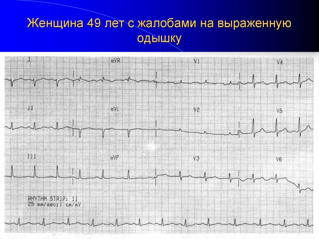 Женщина 49 лет с жалобами на выраженную одышку