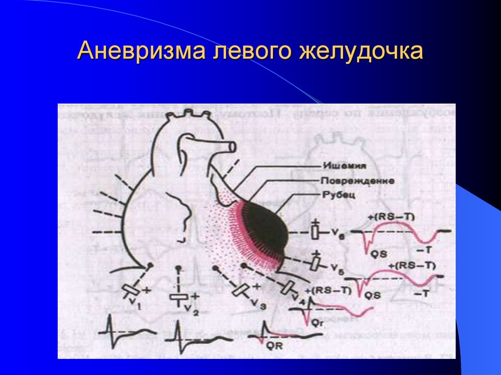 Аневризма левого желудочка