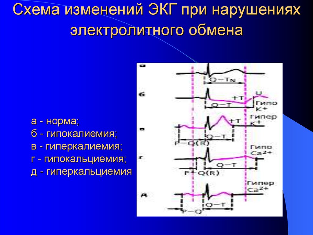 Схема изменений ЭКГ при нарушениях электролитного обмена
