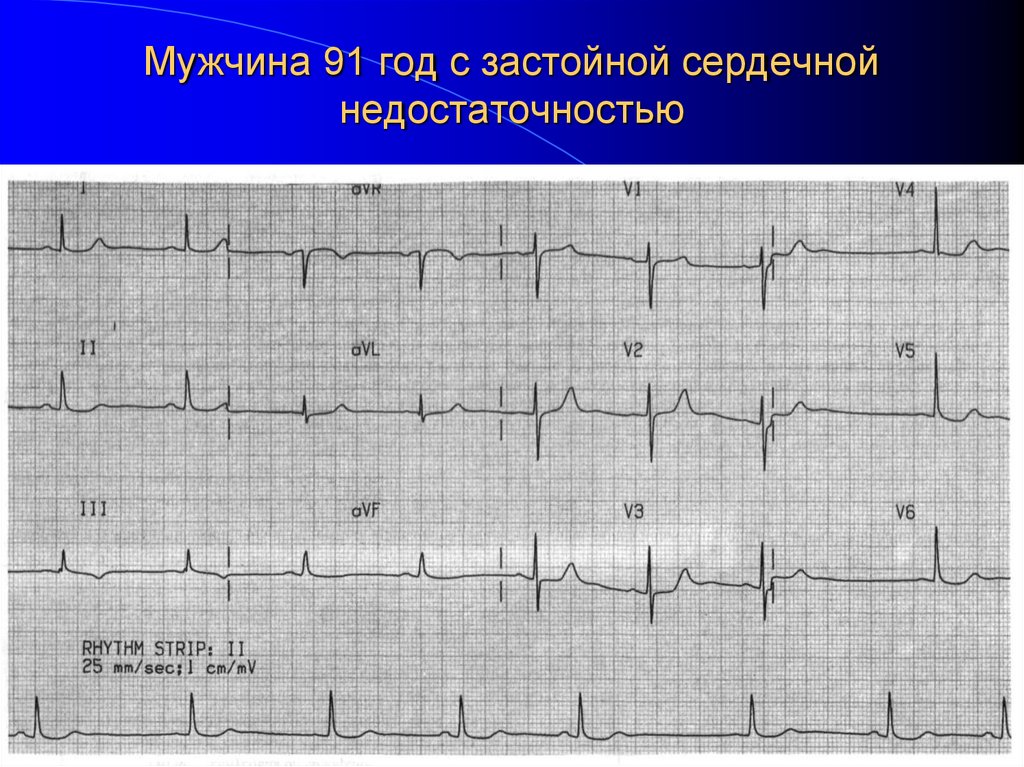 Мужчина 91 год с застойной сердечной недостаточностью