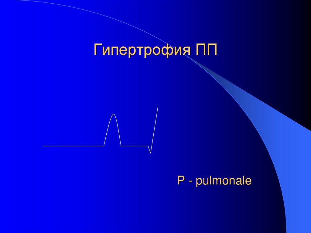 Гипертрофия ПП