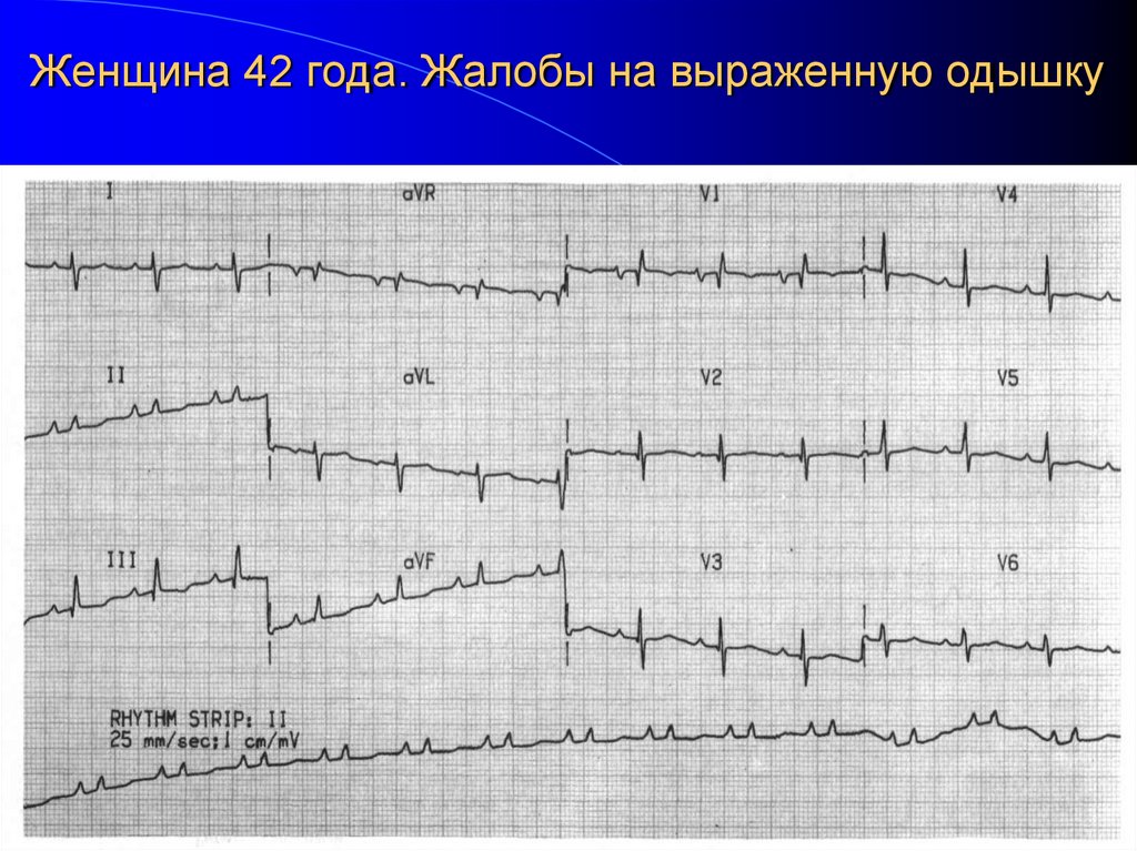 Женщина 42 года. Жалобы на выраженную одышку