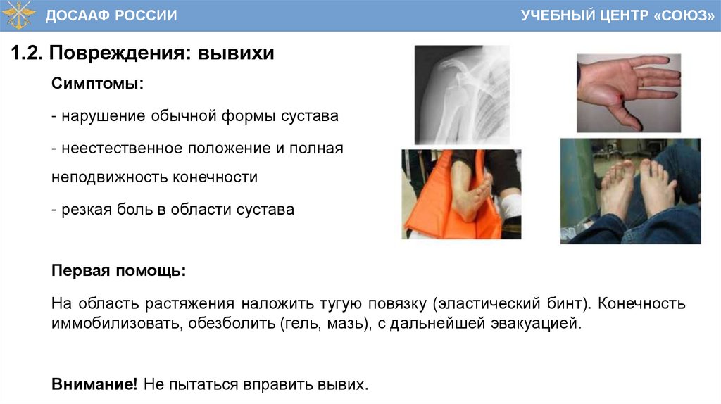 1.2. Повреждения: вывихи