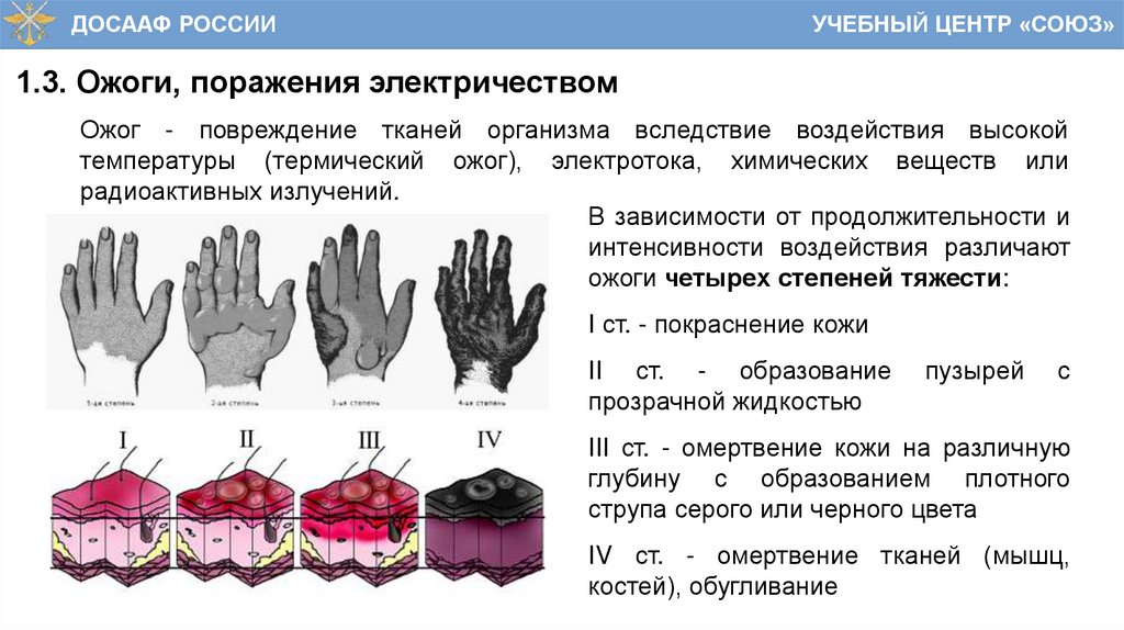 1.3. Ожоги, поражения электричеством