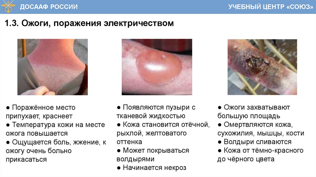 1.3. Ожоги, поражения электричеством