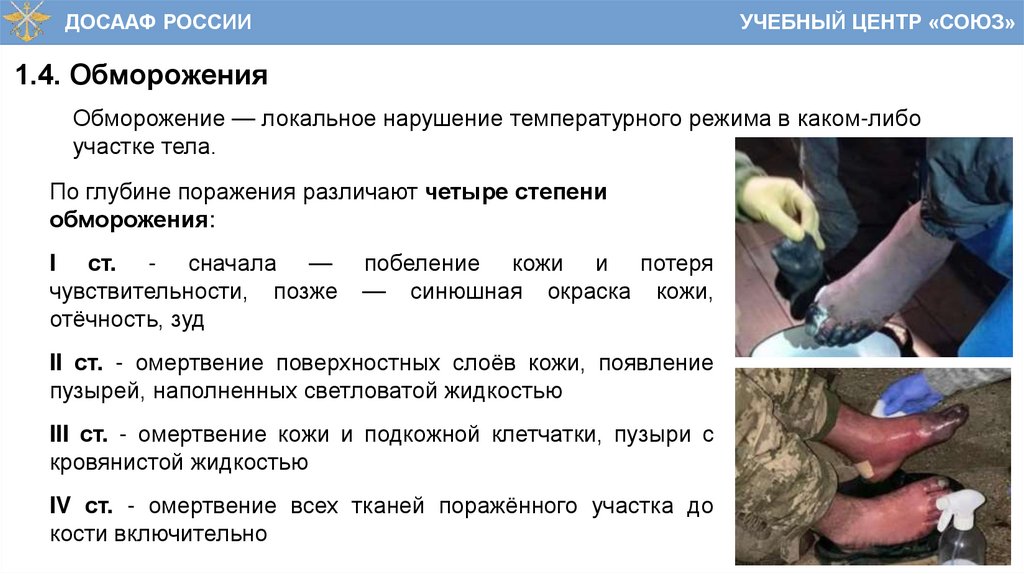 1.4. Обморожения