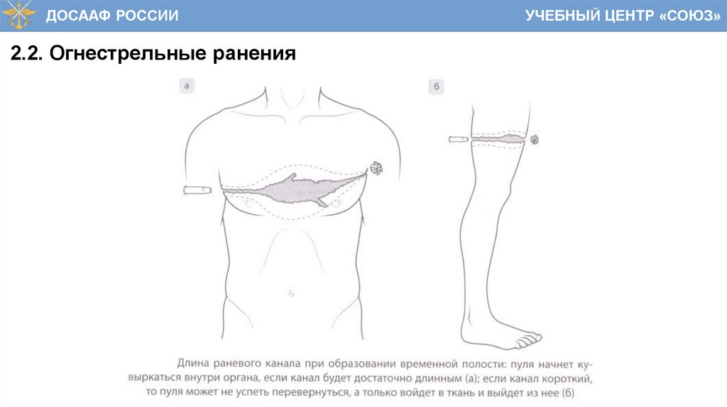 2.2. Огнестрельные ранения
