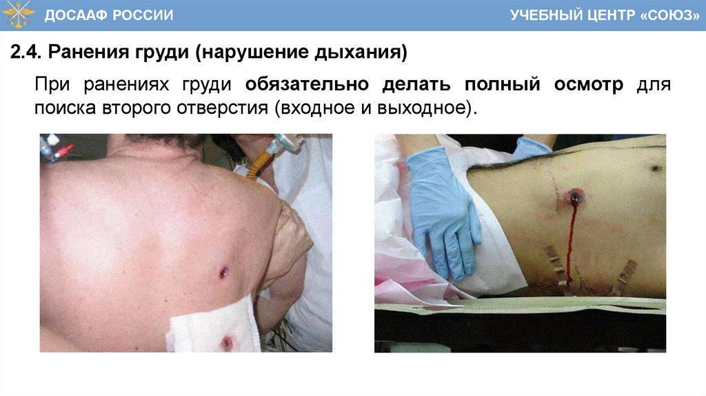 2.4. Ранения груди (нарушение дыхания)