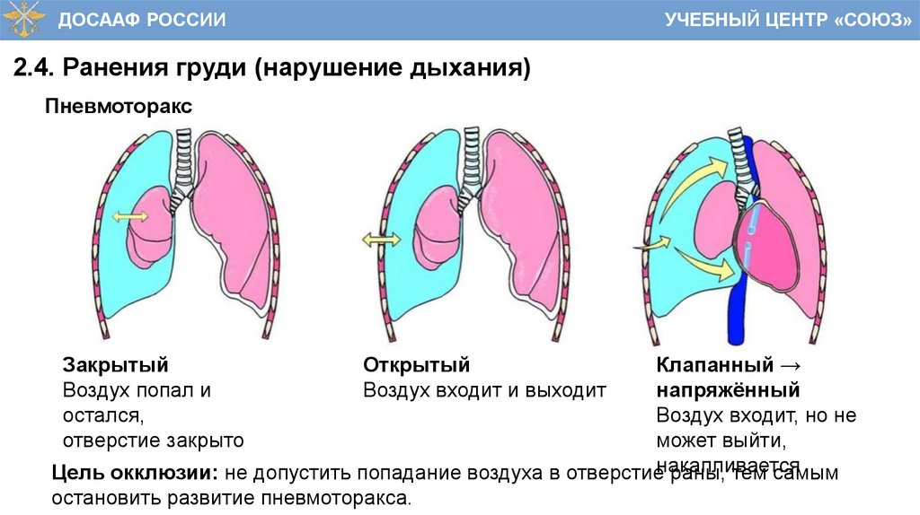 2.4. Ранения груди (нарушение дыхания)