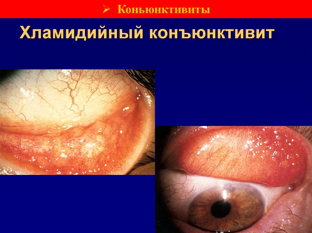 Хламидийный конъюнктивит