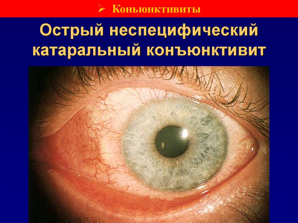 Острый неспецифический катаральный конъюнктивит