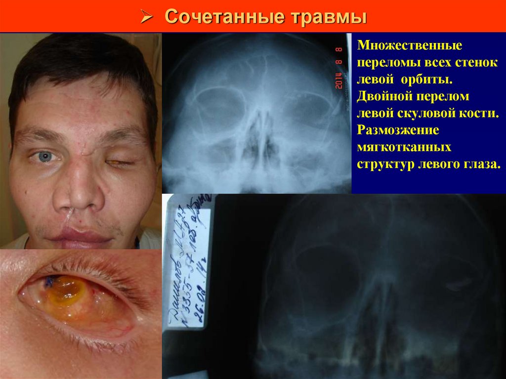 Сочетанные травмы