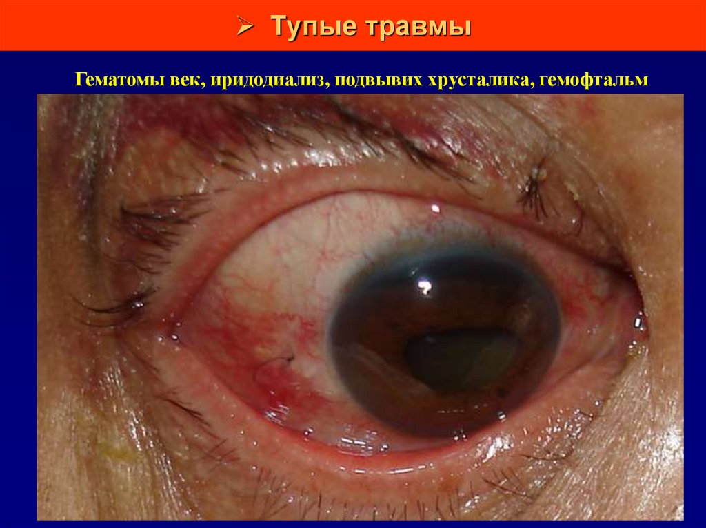 Тупые травмы