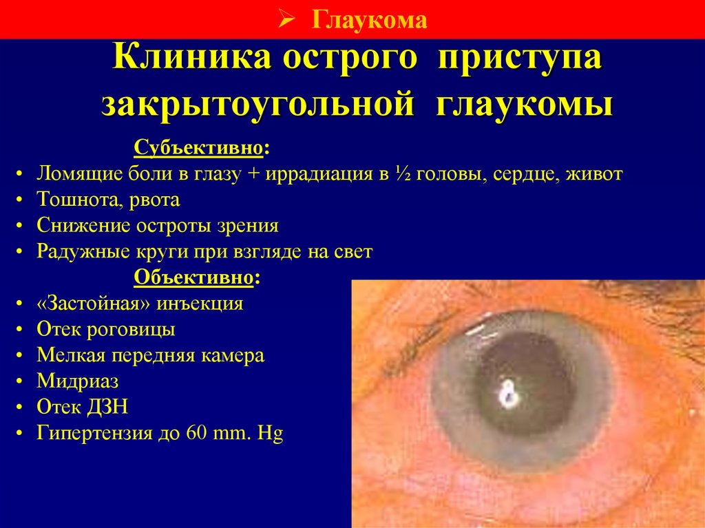 Клиника острого приступа закрытоугольной глаукомы
