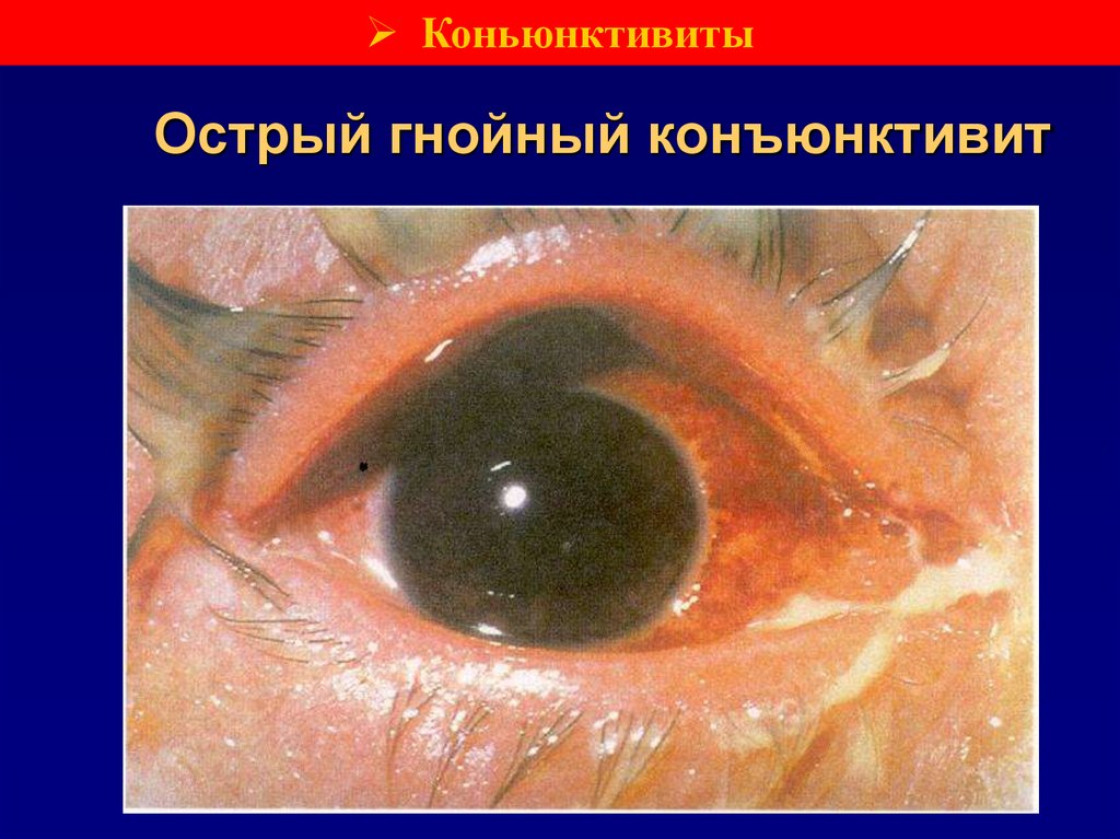 Острый гнойный конъюнктивит