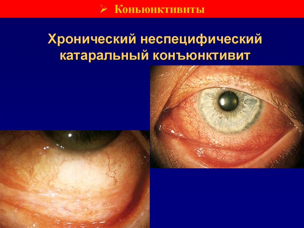 Хронический неспецифический катаральный конъюнктивит