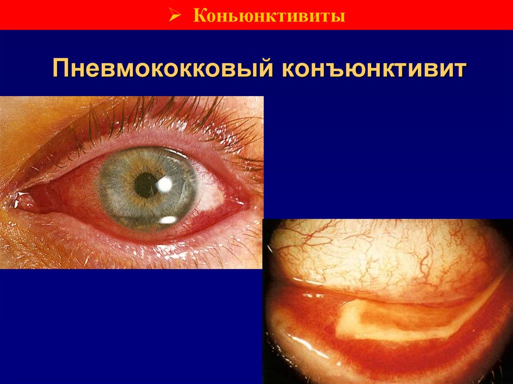 Пневмококковый конъюнктивит