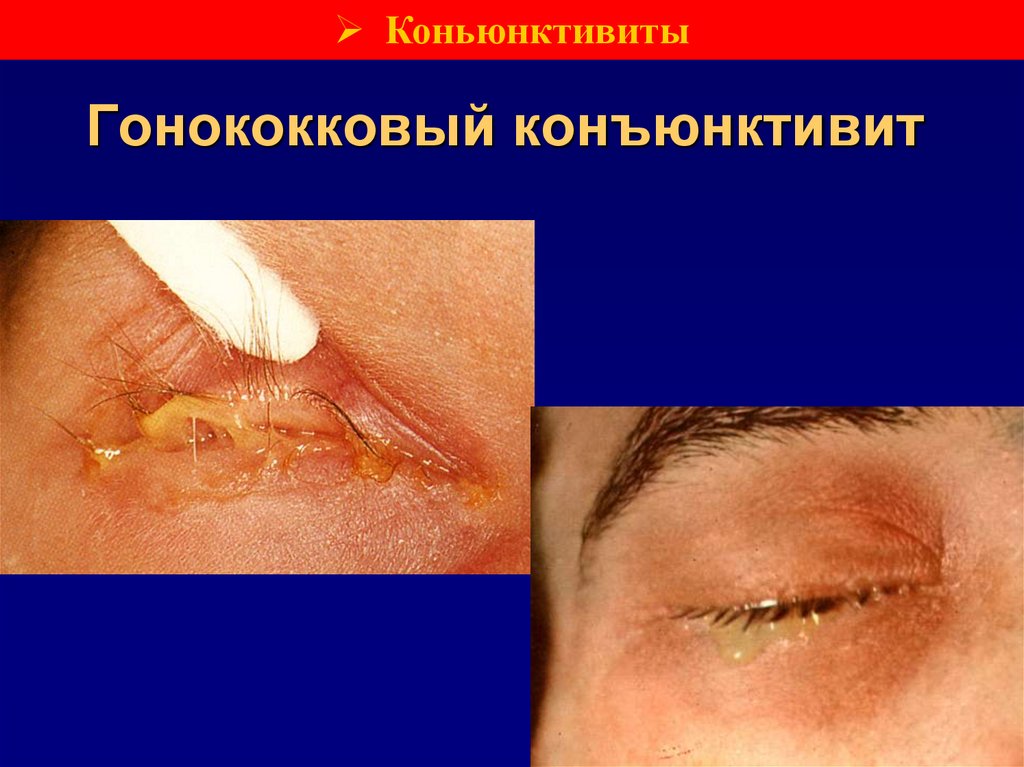 Гонококковый конъюнктивит