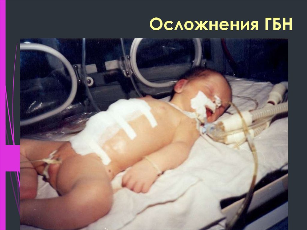 Осложнения ГБН