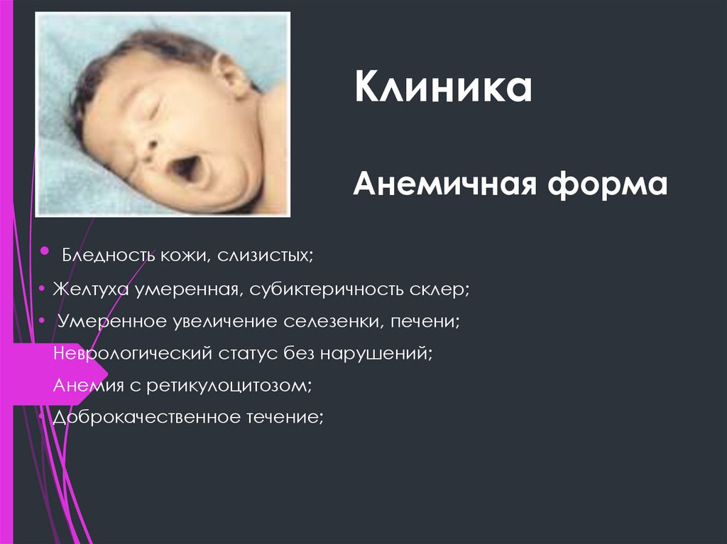 Клиника Анемичная форма