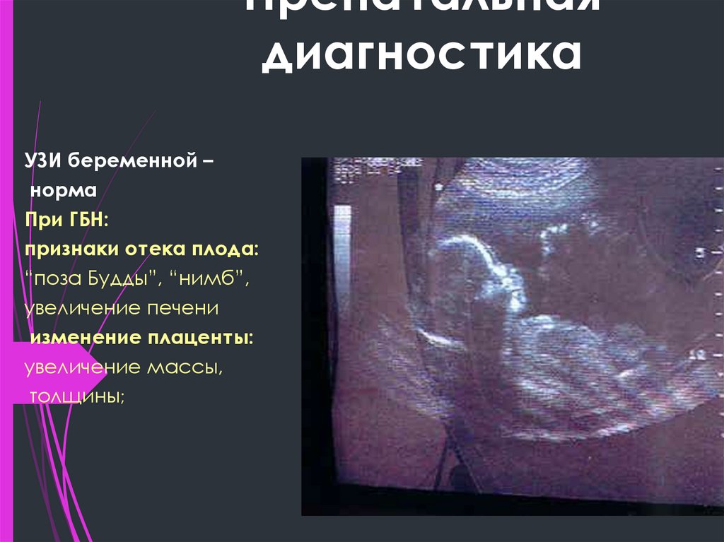 Пренатальная диагностика