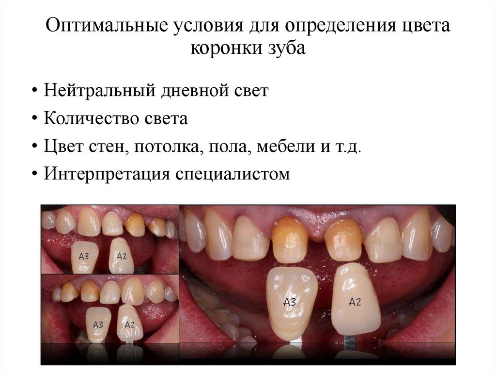 Оптимальные условия для определения цвета коронки зуба