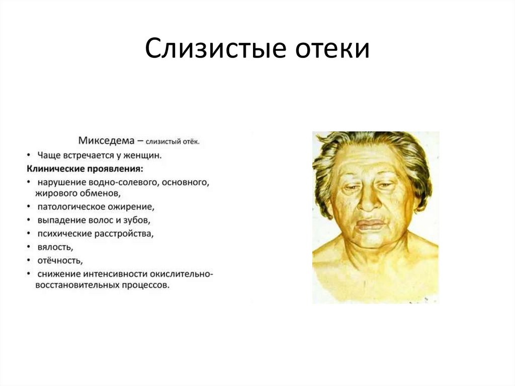 Слизистые отеки