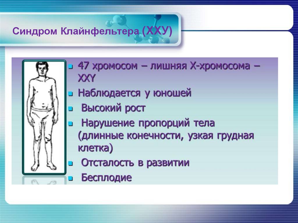 Синдром Дауна (ХХ+21,ХУ+21)