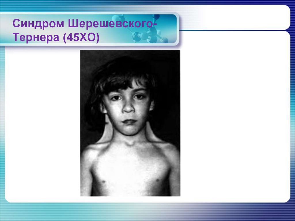 Синдром Клайнфельтера (ХХУ)