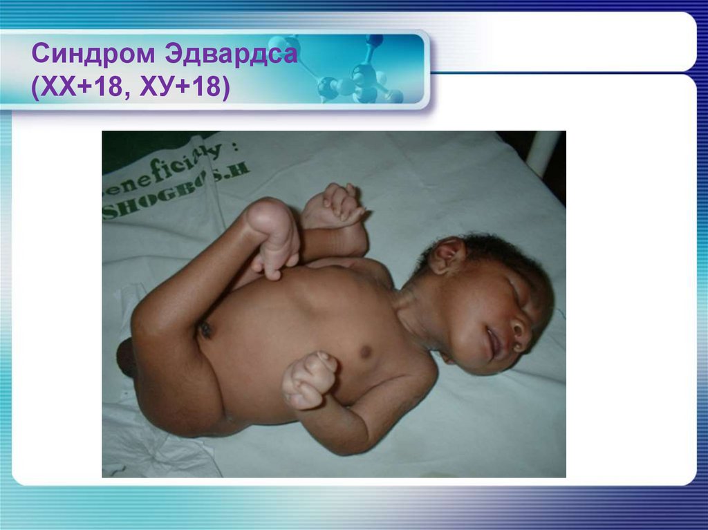 Синдром Шерешевского-Тернера (45ХО)