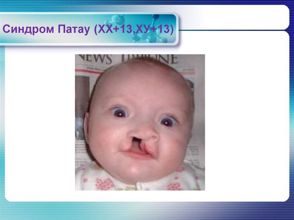 Синдром Эдвардса (ХХ+18, ХУ+18)