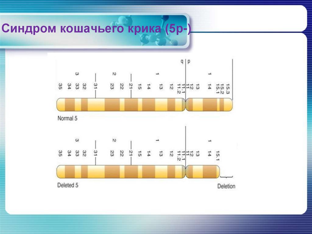 Синдром Патау (ХХ+13,ХУ+13)