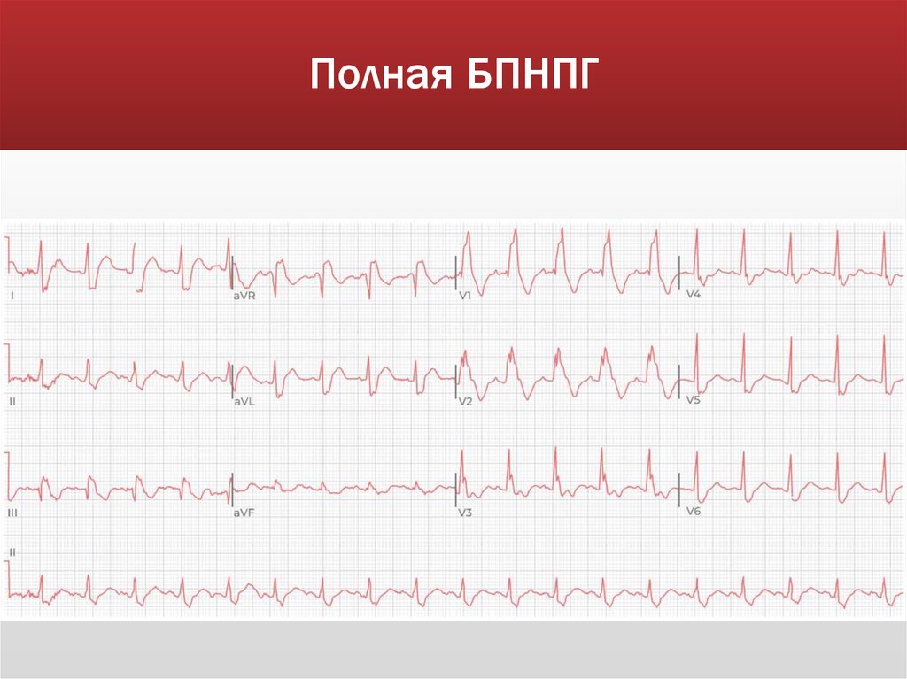 Полная БПНПГ