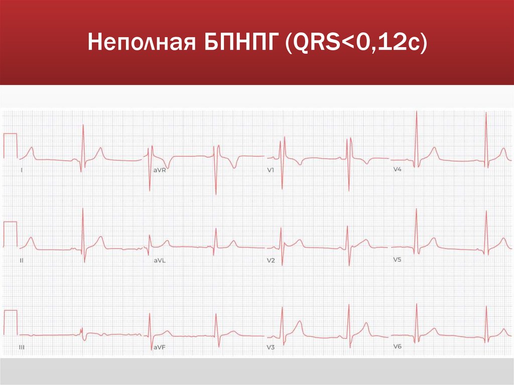 Неполная БПНПГ (QRS<0,12c)