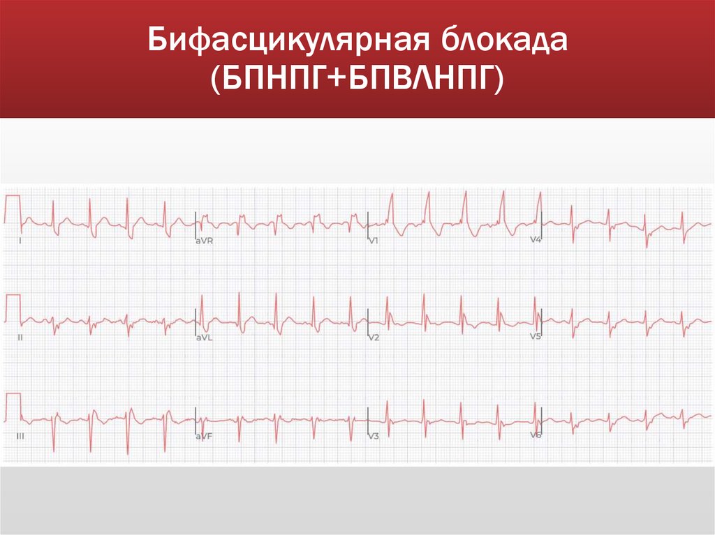 Бифасцикулярная блокада (БПНПГ+БПВЛНПГ)