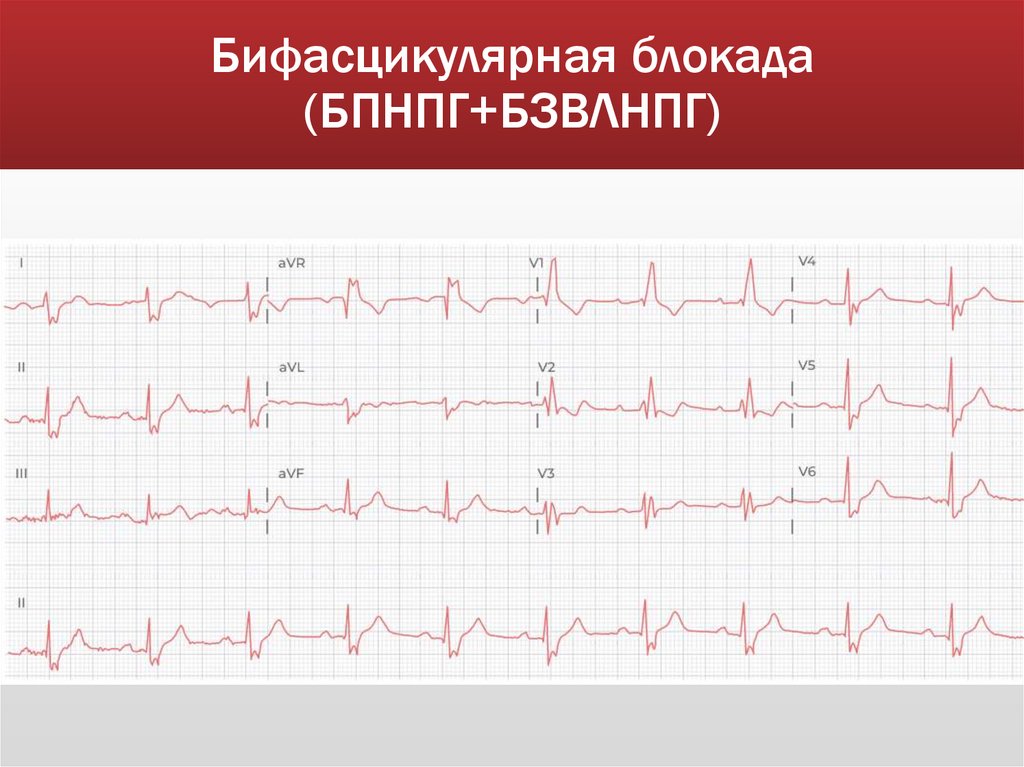 Бифасцикулярная блокада (БПНПГ+БЗВЛНПГ)