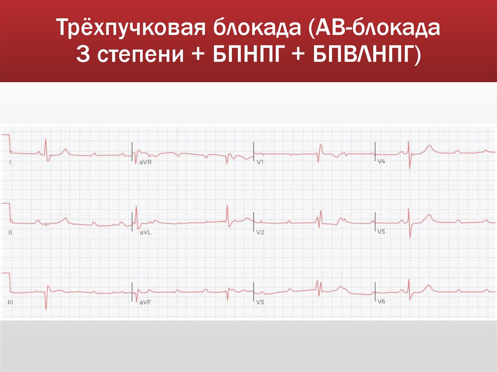 Трёхпучковая блокада (АВ-блокада 3 степени + БПНПГ + БПВЛНПГ)