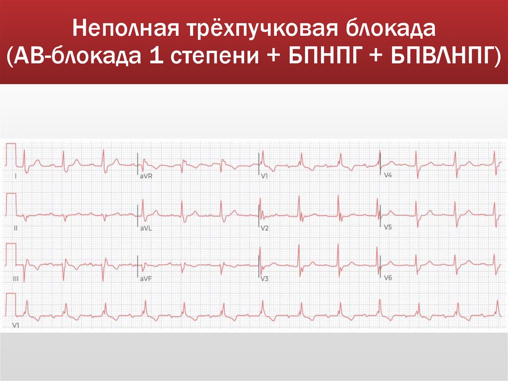 Неполная трёхпучковая блокада (АВ-блокада 1 степени + БПНПГ + БПВЛНПГ)