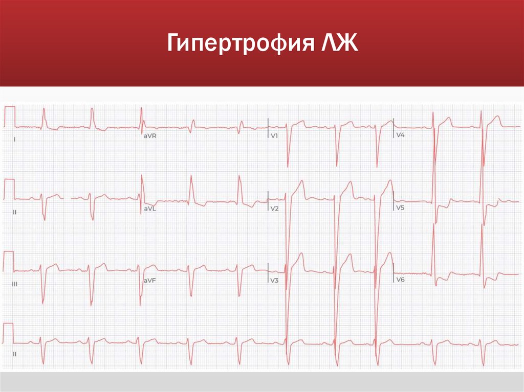 Гипертрофия ЛЖ