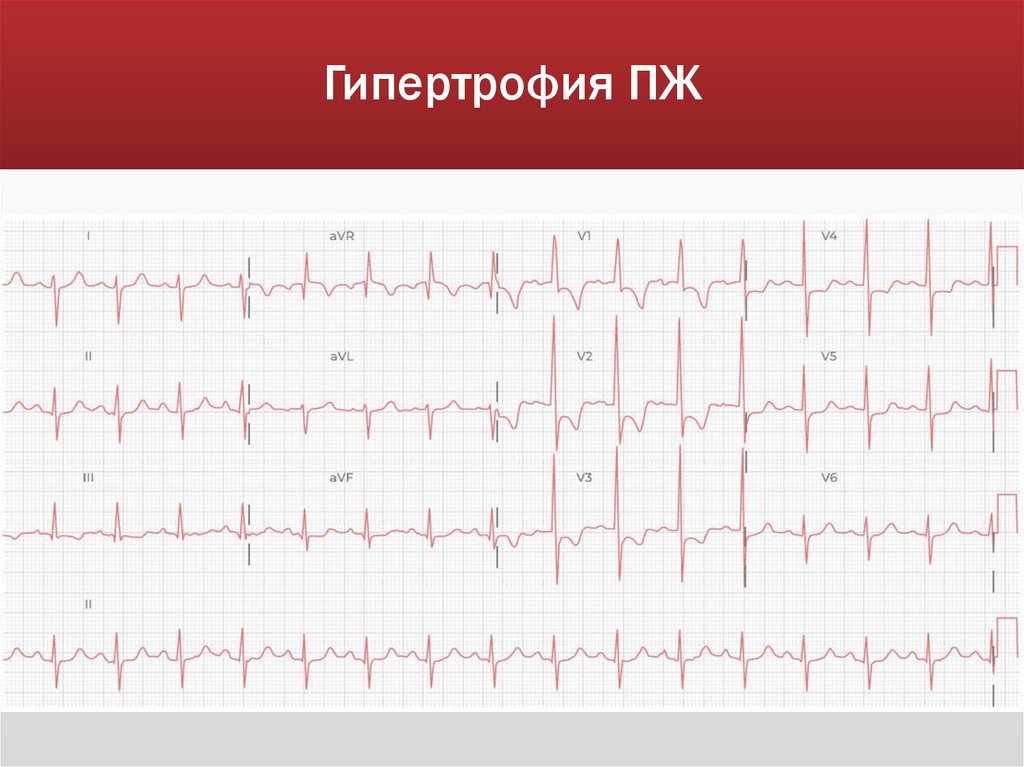 Гипертрофия ПЖ