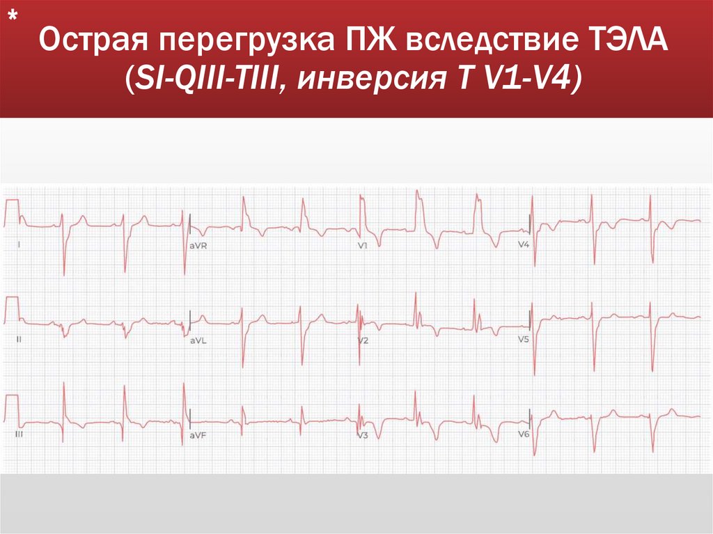 Острая перегрузка ПЖ вследствие ТЭЛА (SI-QIII-TIII, инверсия Т V1-V4)