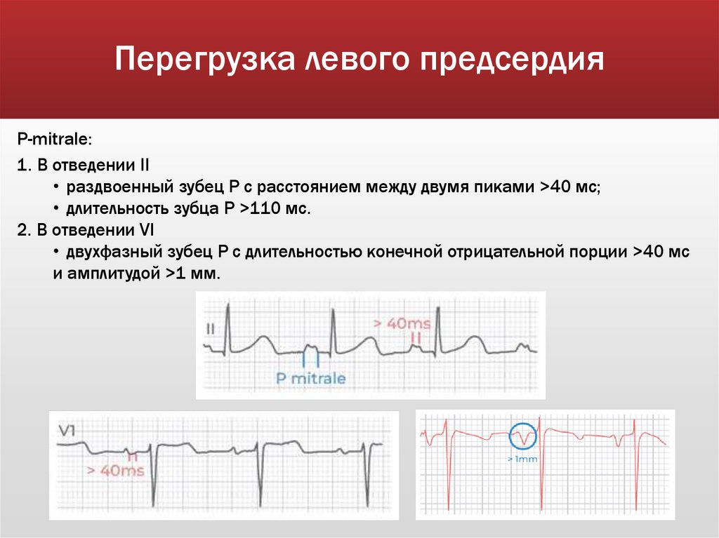 Перегрузка левого предсердия