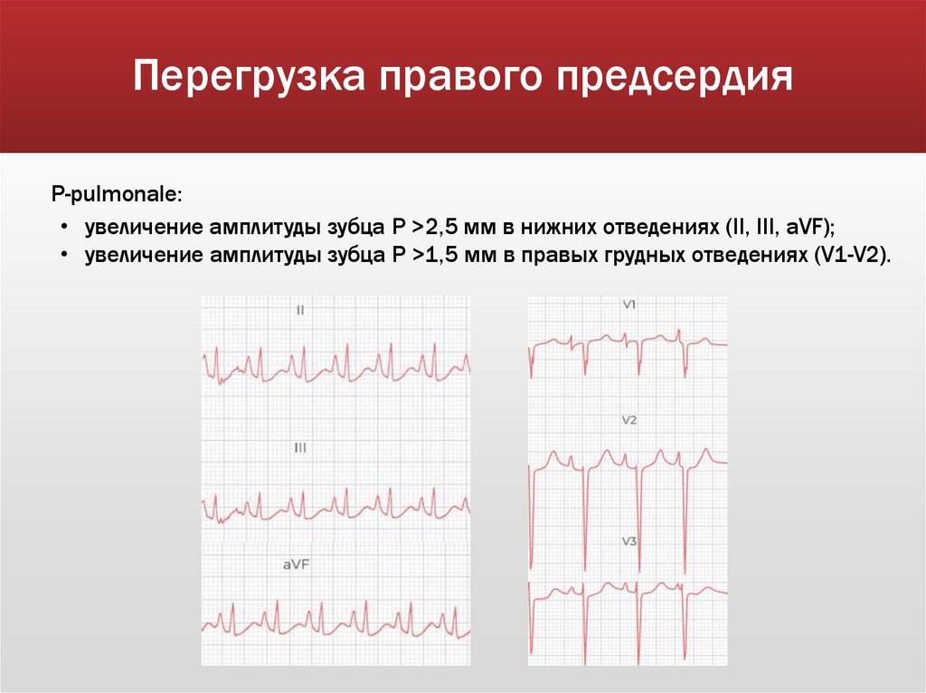 Перегрузка правого предсердия